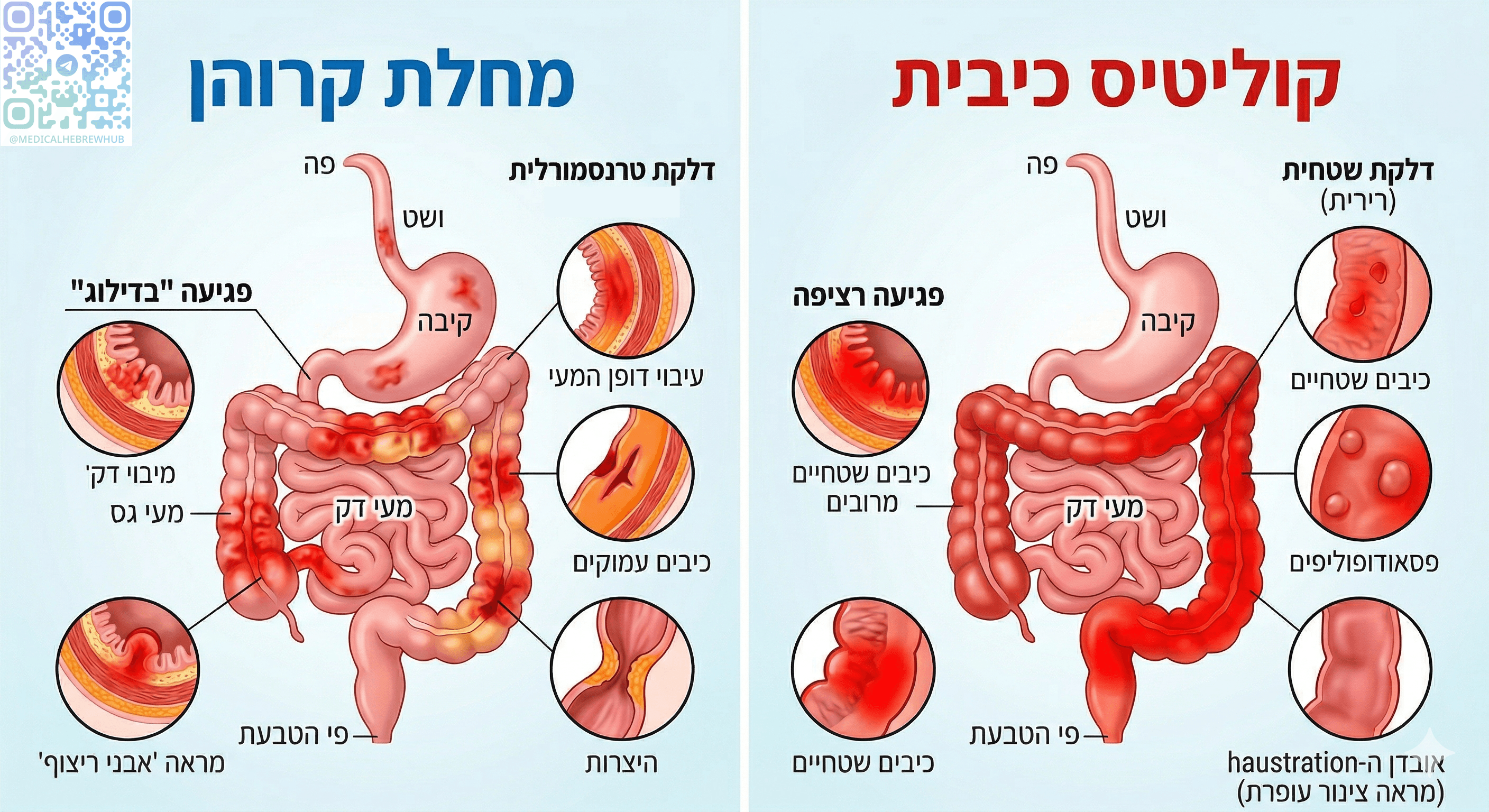 מחלות מעי דלקתיות (IBD) — השוואה