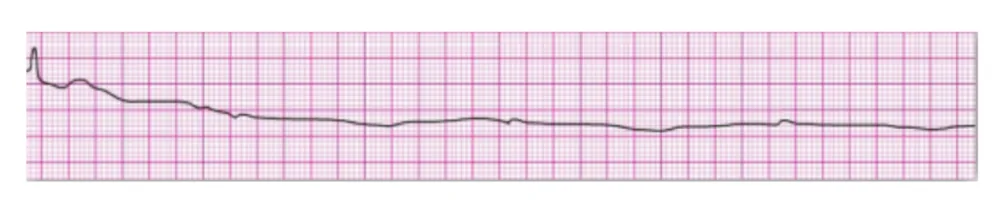 Agonal Rhythm / Asystole
