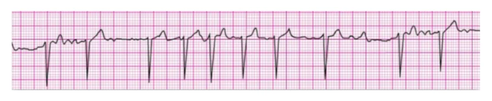 Atrial Fibrillation