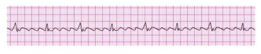Atrial Flutter