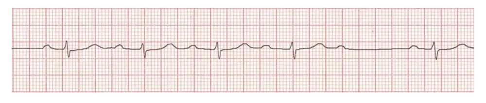 2nd Degree AV Block — Type 1
