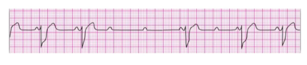 2nd Degree AV Block — Type 2