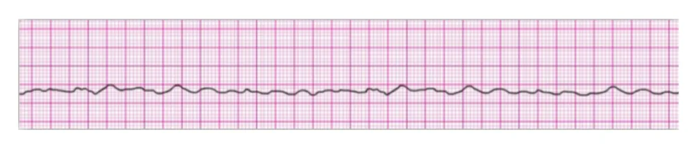 Fine Ventricular Fibrillation