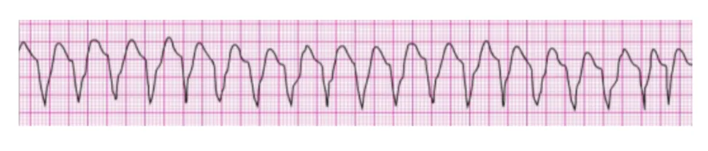 Polymorphic Ventricular Tachycardia