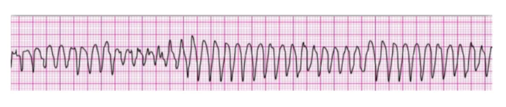 Pulseless Electrical Activity (PEA)