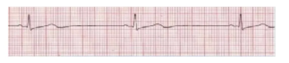 Sinus Bradycardia