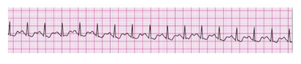 Supraventricular Tachycardia