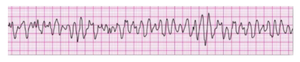 Ventricular Fibrillation