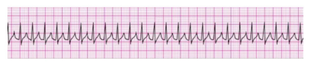 Ventricular Tachycardia